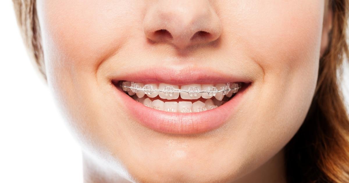 Orthodontic service in Richmond Hill