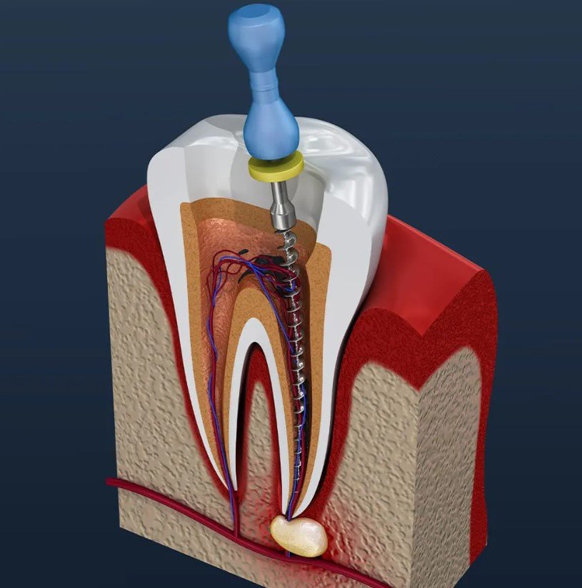 Root Canal Cost Ontario