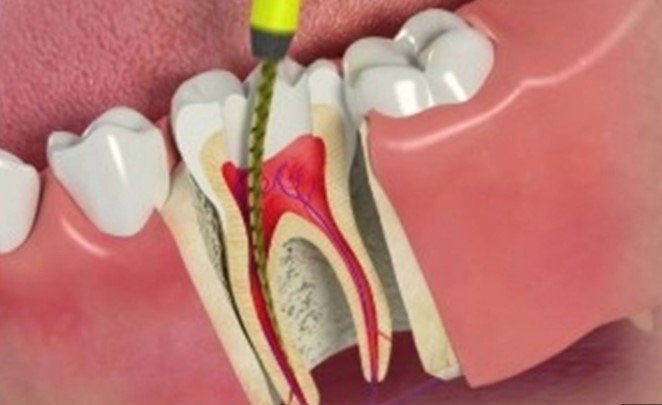 are root canals bad for you