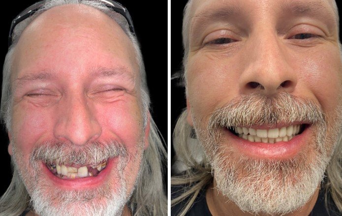 Before And After Dentures