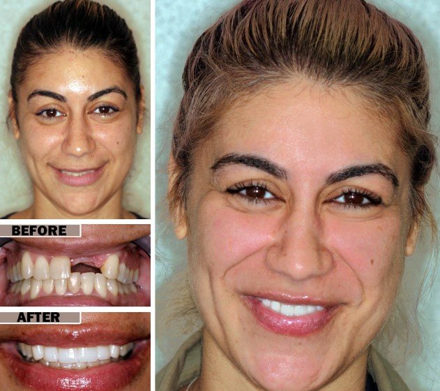 Dentures before And After