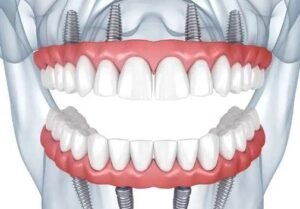Upper Denture Implants Cost
