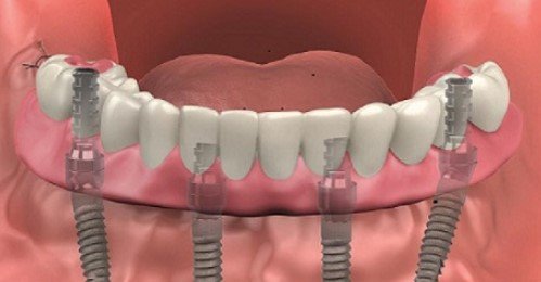 how much do denture implants cost