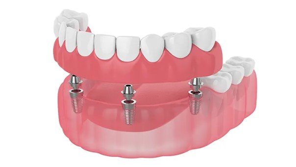 implant dentures price