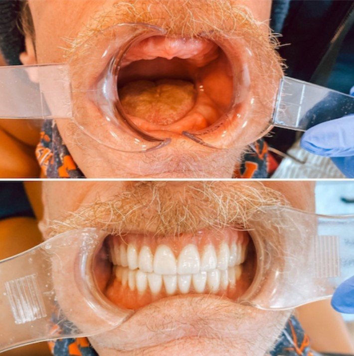 Dentures That Look Real