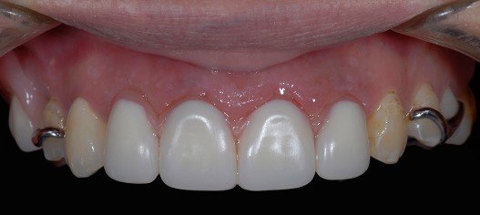 Front Tooth Denture