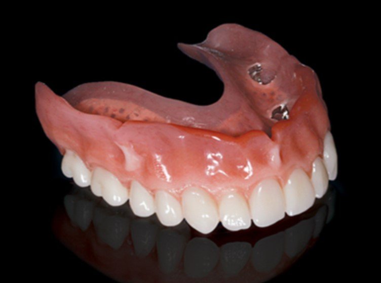 Implant Supported Upper Denture