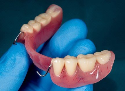 Partial Dentures for Molars
