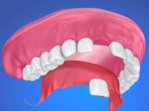 Single tooth denture