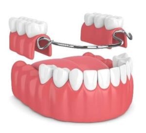 one tooth partial denture