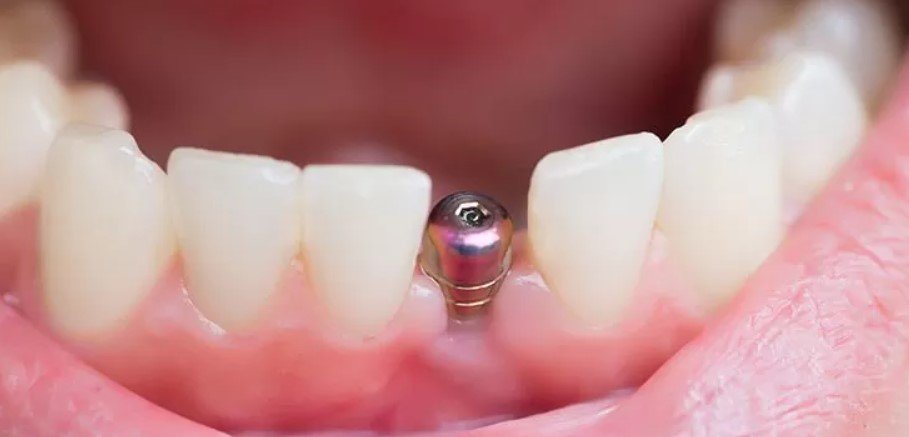 permanent denture implants