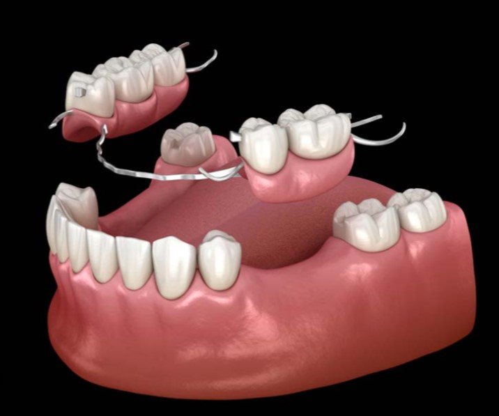 Permanent Partial Denture