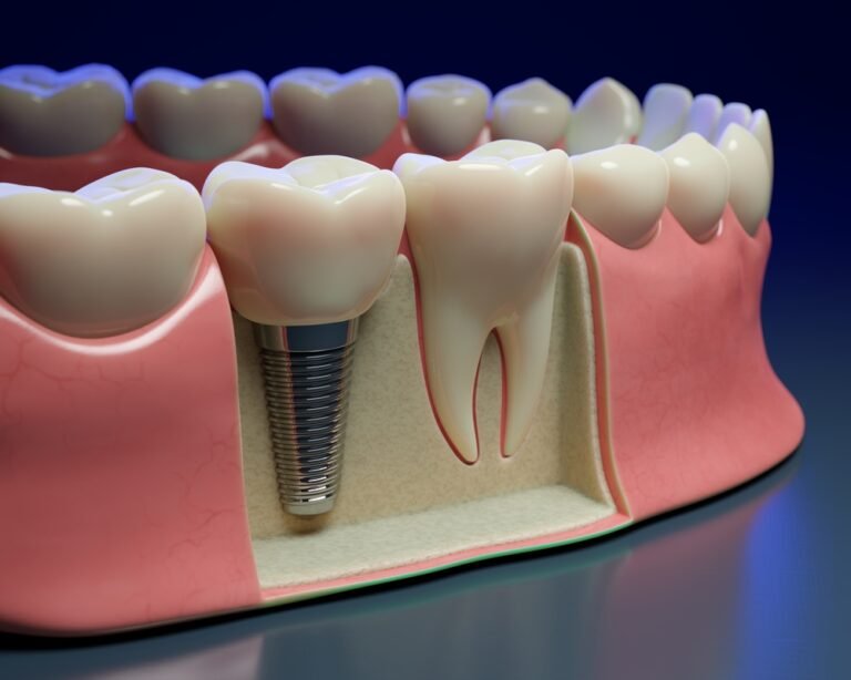 Dental Implant Cost