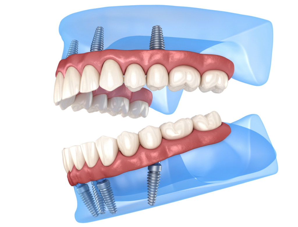 all on 4 dental implants