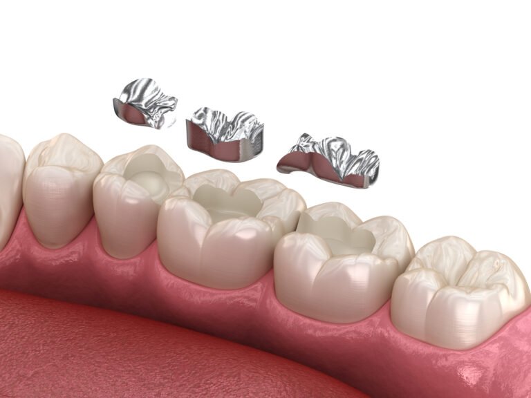 dental filling without insurance