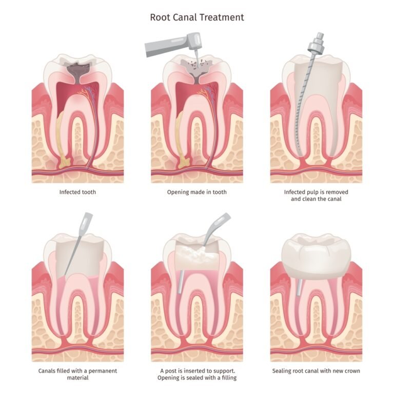 root canal recovery timeline