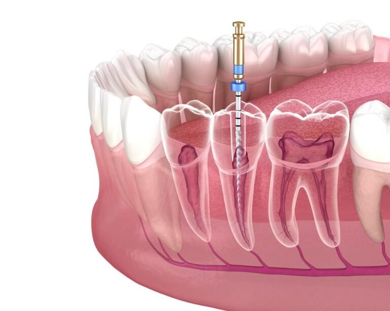 root canal