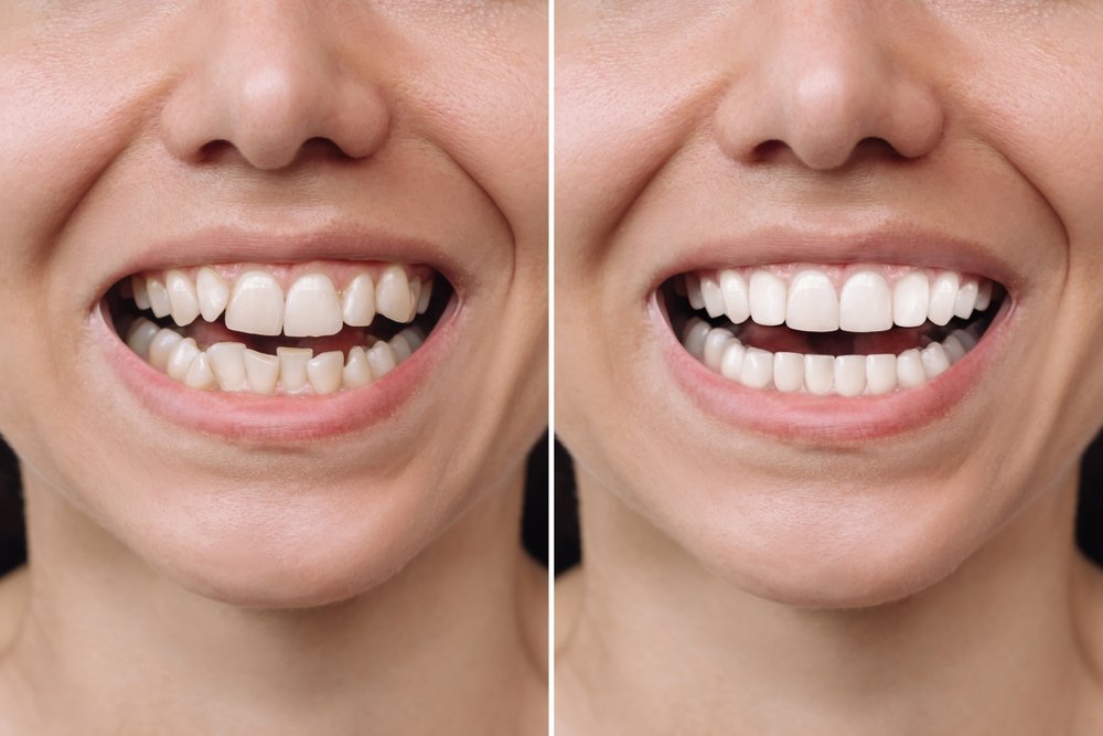 celebrity dental implants before and after