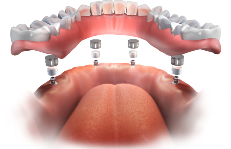 lower denture implants