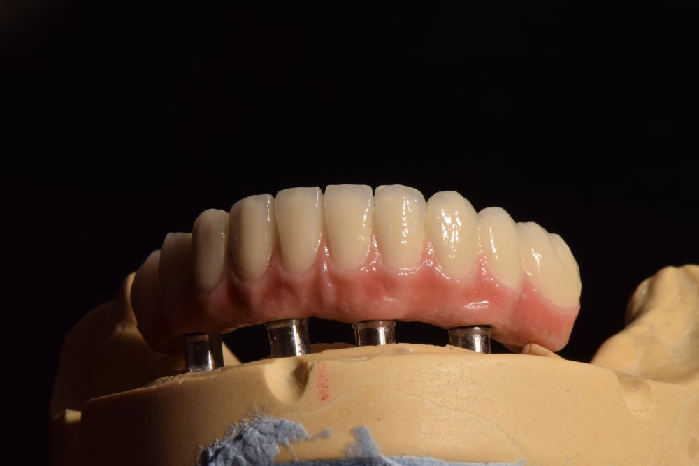 what is a hybrid denture