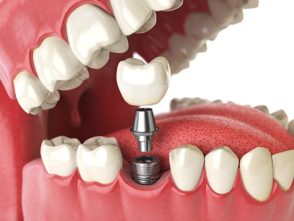 cost of dental implants in ontario