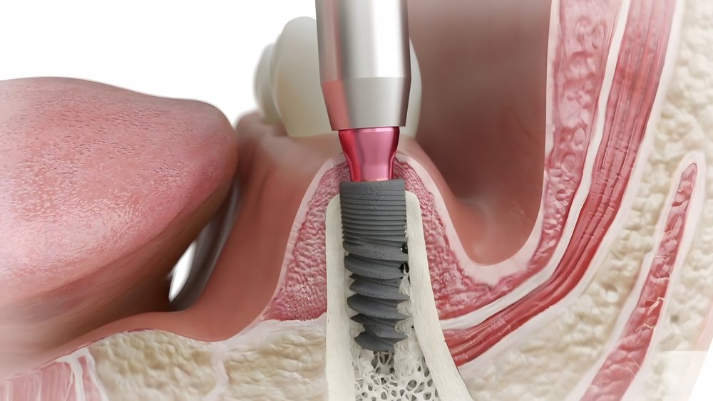 dental implants cost