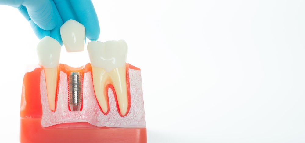 tooth implant vs dental bridge