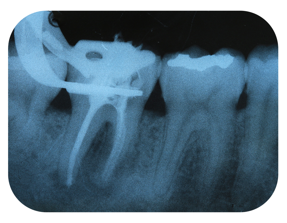 how long does it take for a root canal procedure