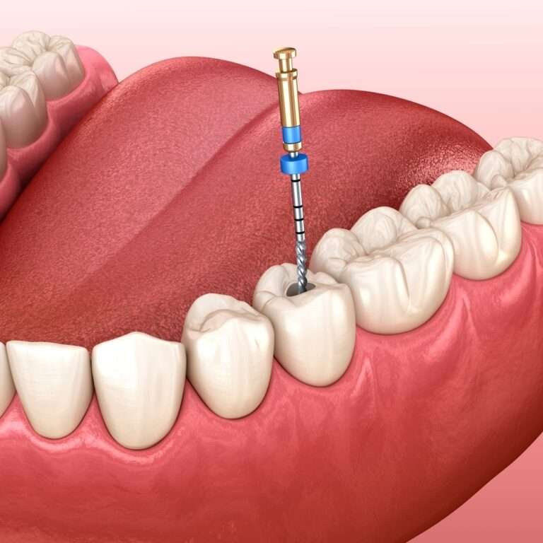 How to Avoid Root Canal