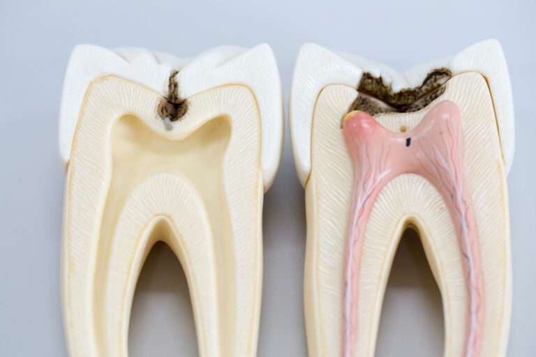 alternative to root canal