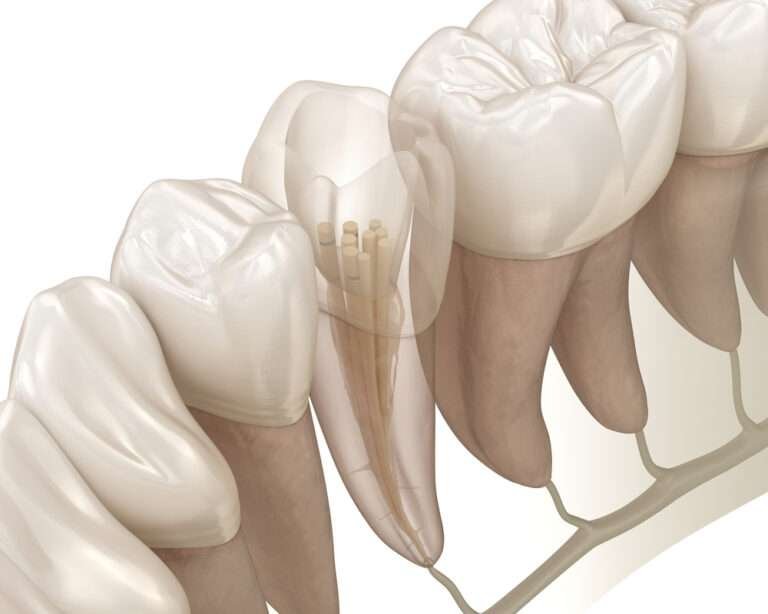 how do i know if i need a root canal