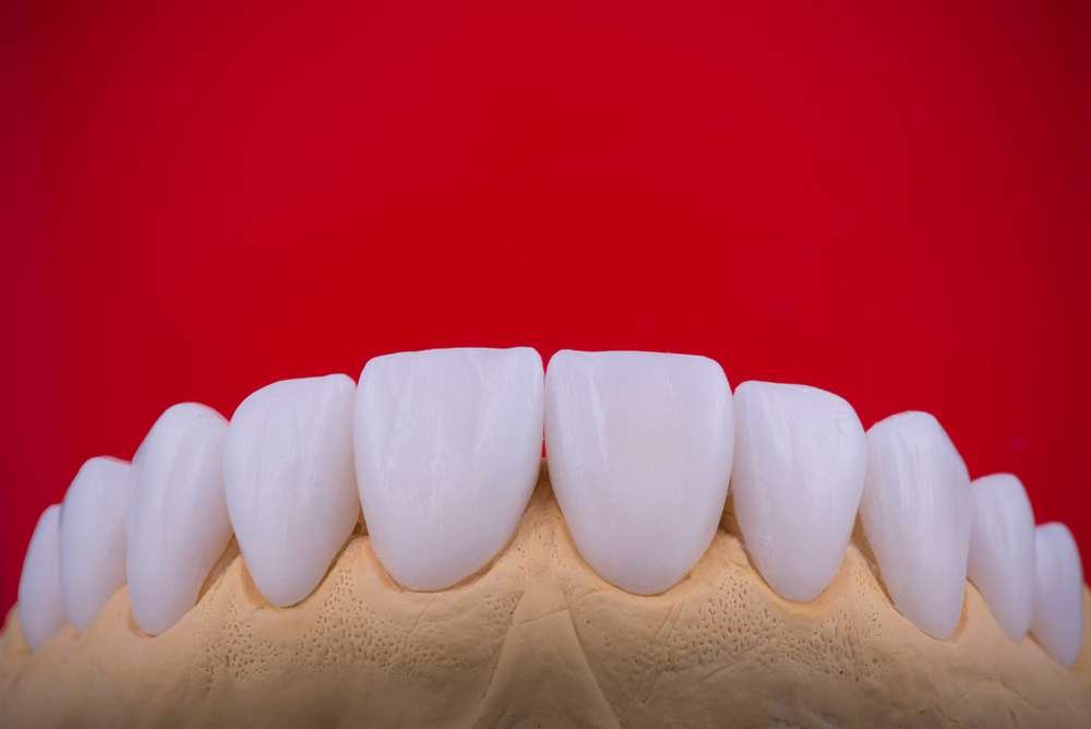 Can Veneers Fix Your Smile If You’ve Lost Teeth?