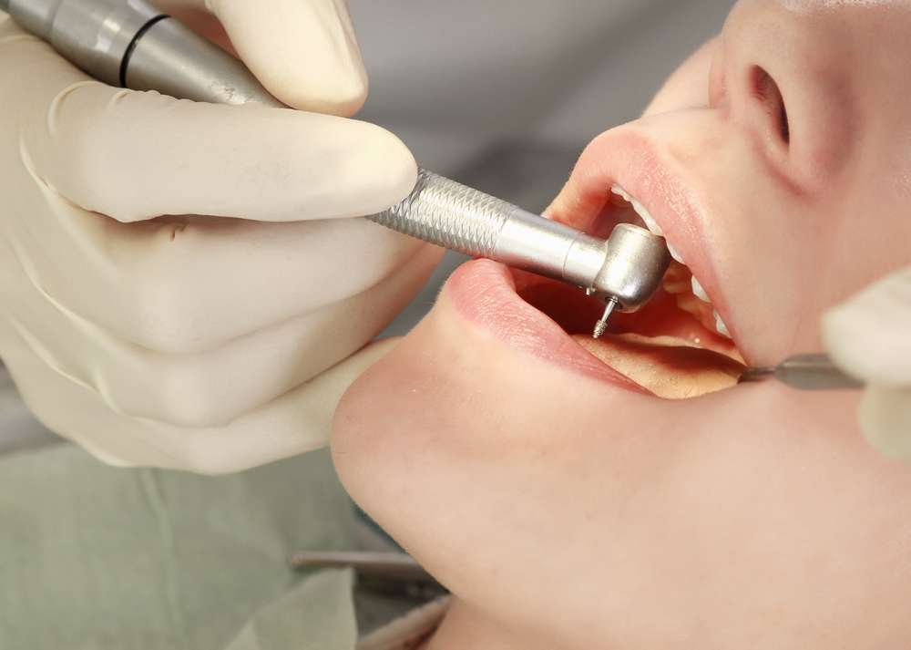 dental filling services