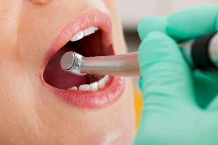 how long does dental filling last