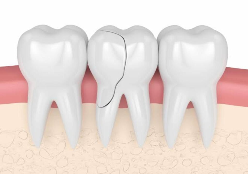 Cracked Tooth Root Canal