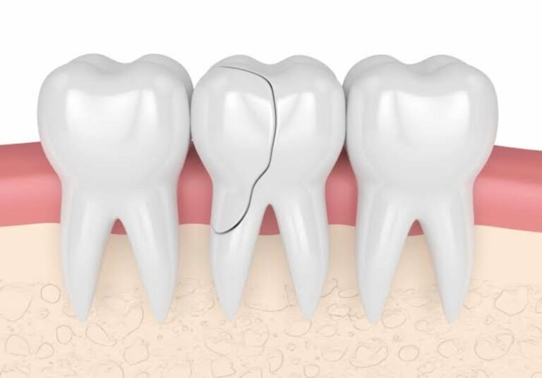 Cracked Tooth Root Canal