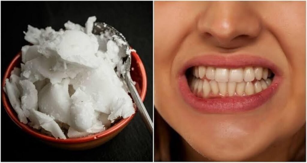 Does Oil Pulling Whiten Teeth