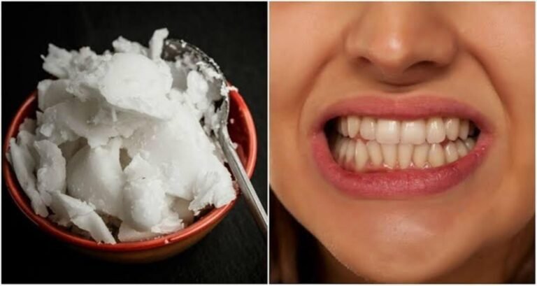 Does Oil Pulling Whiten Teeth