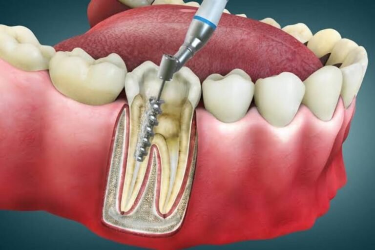 Root Canal Cost Richmond