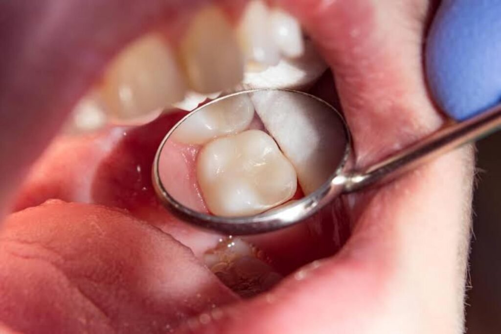 How to Tell if You Need a Root Canal