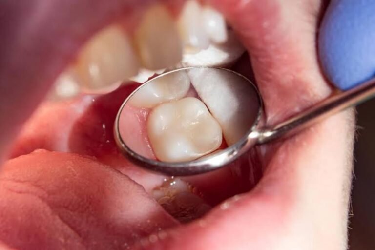 How to Tell if You Need a Root Canal