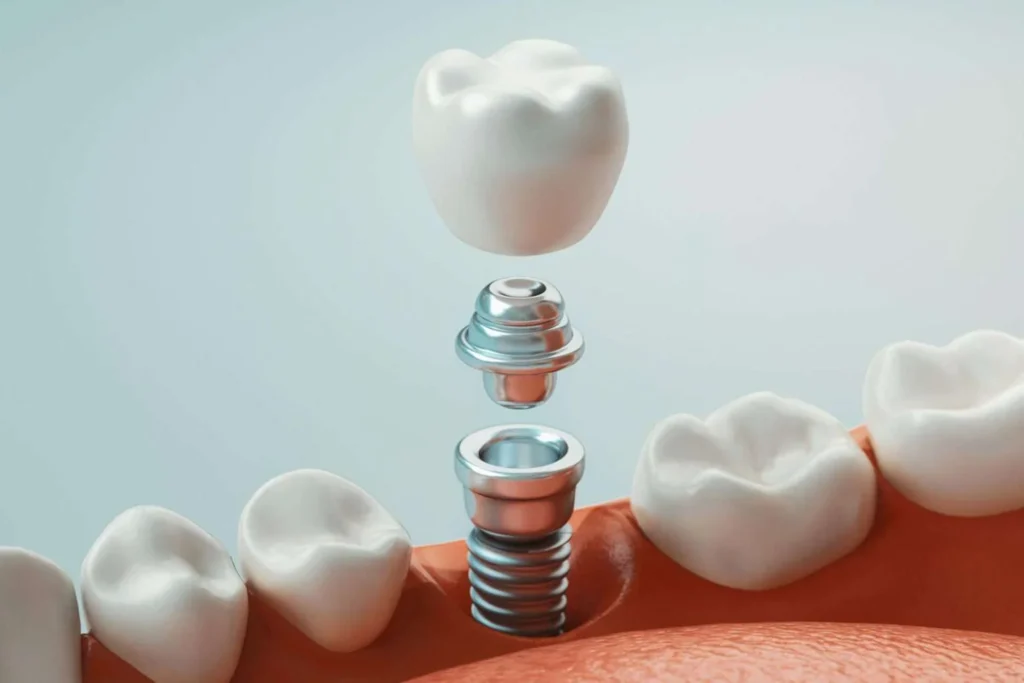 Illustration of a dental implant being placed to replace a missing tooth