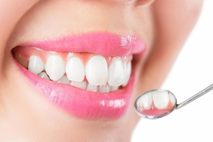Bright natural-looking smile after porcelain veneers