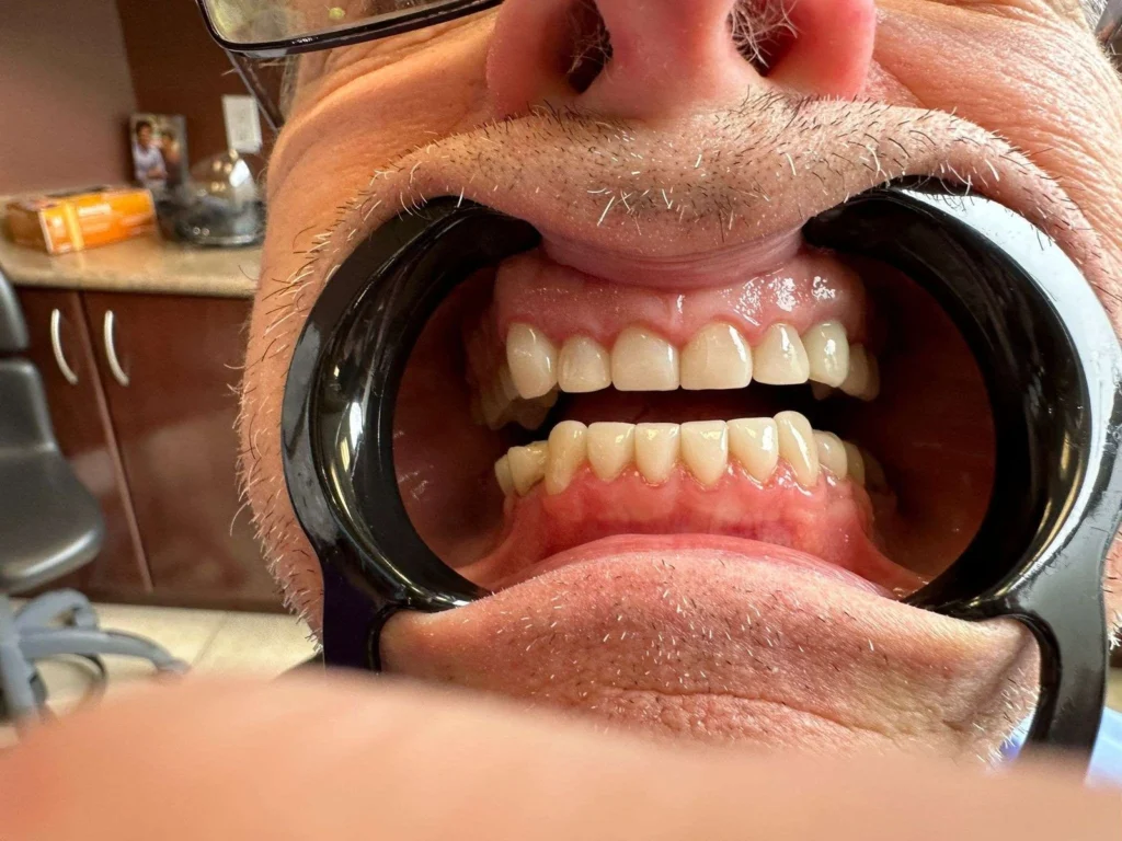 Cheek retractor photo taken to plan porcelain veneers