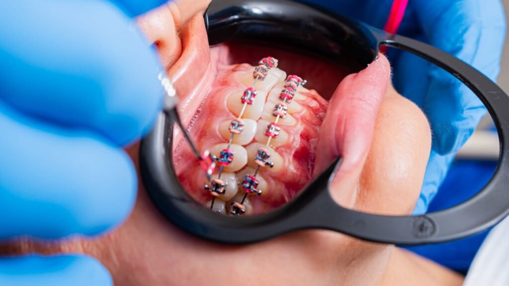 Do Braces Hurt?
