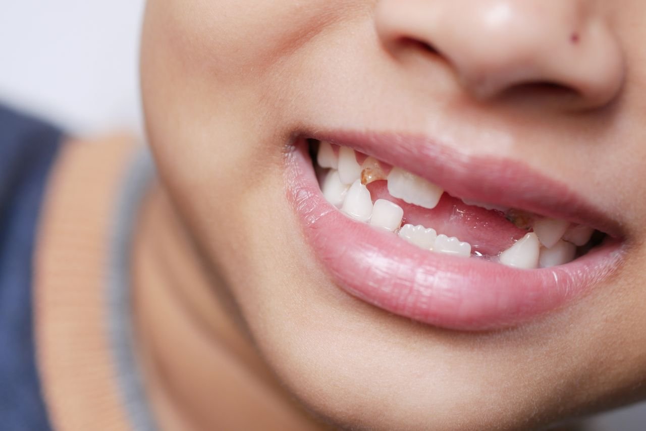 Close-up of a child with a missing front tooth